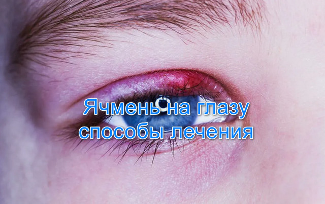 Ячмень на глазу причины, симптомы и способы лечения